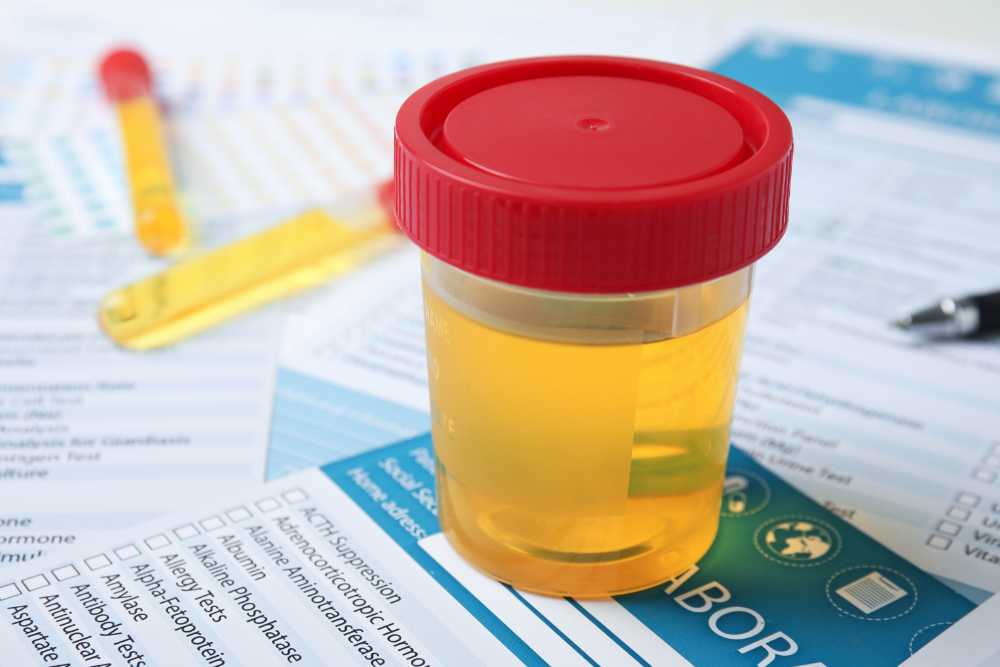 large cup of urine for drug test on paperwork