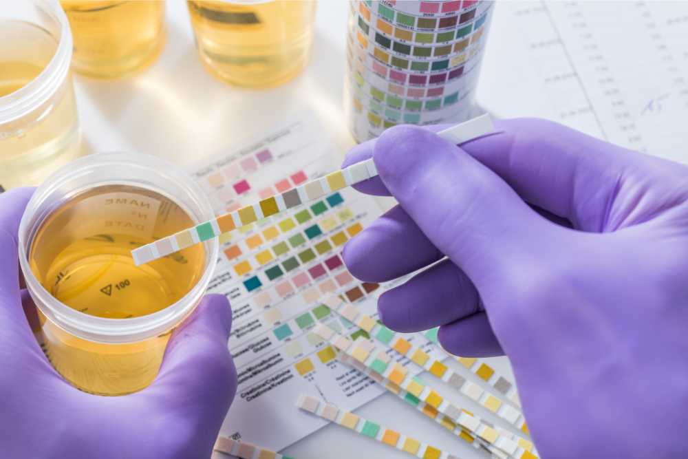 urine test strips held by purple gloved hands